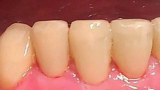 Dianne - Composite Veneers after
