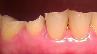 Dianne - Composite Veneers before