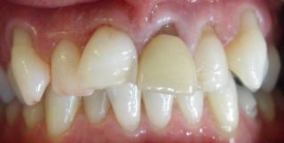 Robert - Porcelain Crowns before