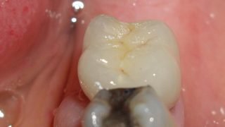 Gemma - Dental Implants after