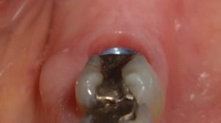 Gemma - Dental Implants before