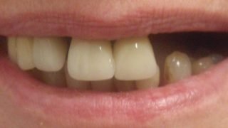Janet - Dental Implants before
