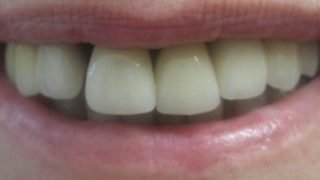 Janet - Dental Implants after