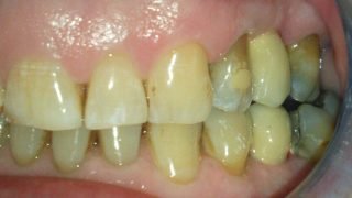James - Dental Implants after