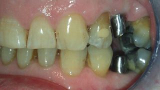 James - Dental Implants before