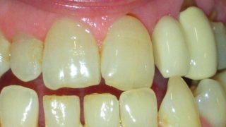 Clare - Adhesive Bridges, Porcelain Crowns before