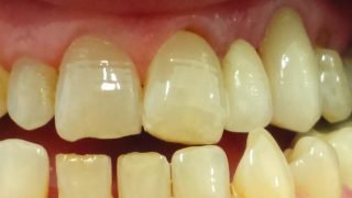 Clare - Adhesive Bridges, Porcelain Crowns after