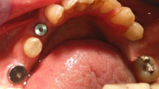 Stacey - Dental Implants before