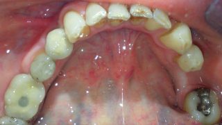 Stacey - Dental Implants after