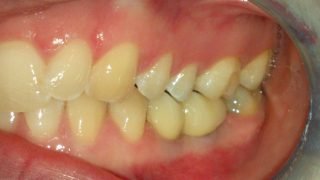 Annie - Dental Implants after