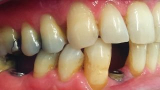 Ronald - Dental Implants before
