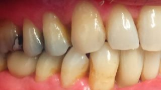 Ronald - Dental Implants after