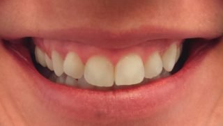 Tilly - Composite Veneers before