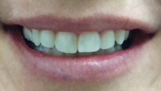 Tilly - Composite Veneers after