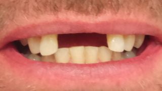 Robert - Dental Implants before
