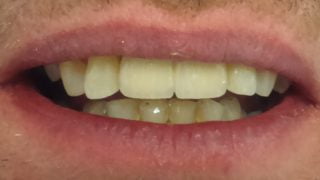 Robert - Dental Implants after