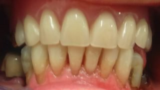 May - Composite Veneers after