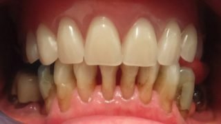 May - Composite Veneers before