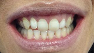 Lizzie - Teeth Whitening before