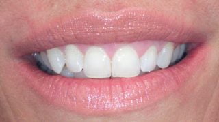 Lizzie - Teeth Whitening after