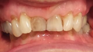Mary - Porcelain Veneers before
