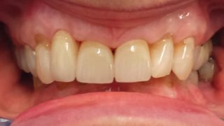 Mary - Porcelain Veneers after