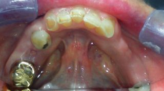 Maggie - Dental Implants before