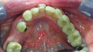 Maggie - Dental Implants after