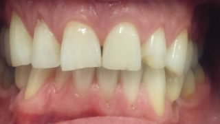 Derek - Composite Veneers before
