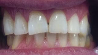 Derek - Composite Veneers after