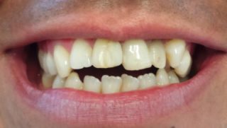 James - Porcelain Veneers before