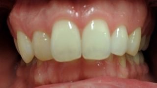 Jack - Composite Veneers before