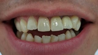 James - Porcelain Veneers after