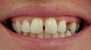 Susan - Dental Implants before