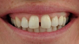 Susan - Dental Implants after