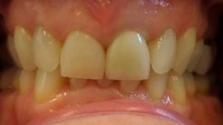 Edith - Porcelain Crowns after