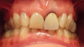 Edith - Porcelain Crowns before