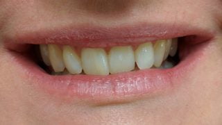 Susan - Teeth Whitening before