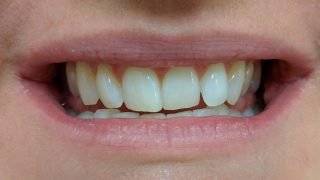 Susan - Teeth Whitening after
