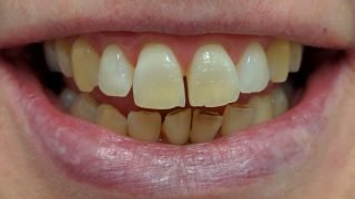 Georgina - Teeth Whitening before