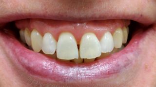 Georgina - Teeth Whitening after