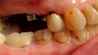 Jean - Dental Implants, Porcelain Crowns before