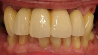Howard - Dental Implants after