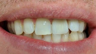 Tom - Porcelain Crowns after