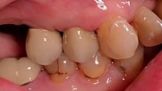 Jean - Dental Implants, Porcelain Crowns after