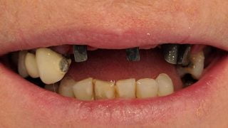 Penny - Dental Implants before
