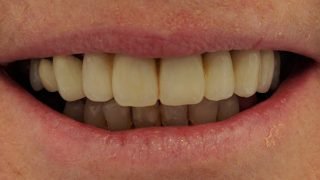 Penny - Dental Implants after