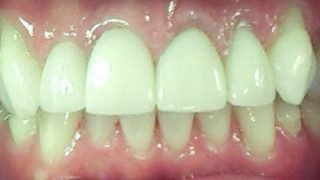 Robert - Porcelain Crowns after
