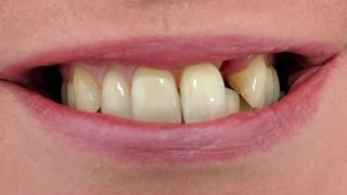 Julia - Dental Implants before