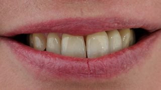 Julia - Dental Implants after